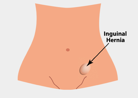 Hérnia Femoral x Inguinal: quais as diferenças? - SBH