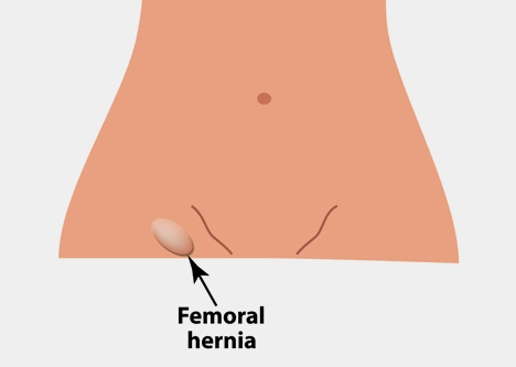 Inguinal Hernia