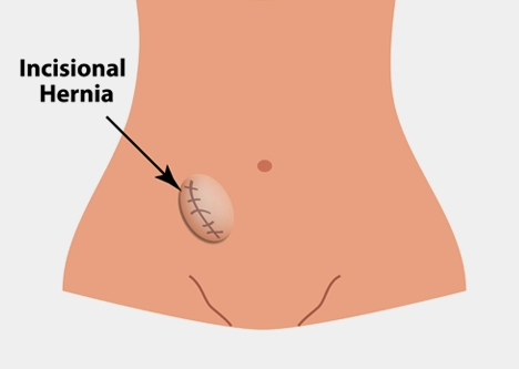 Inguinal Hernia